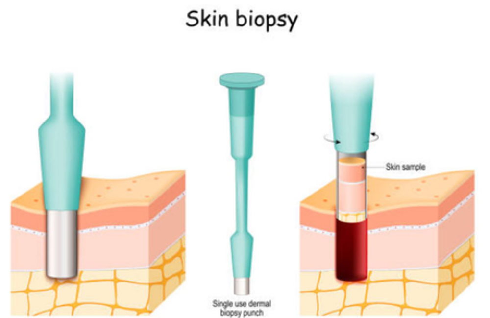 Acne Scarring Metropolis Dermatology Los Angeles