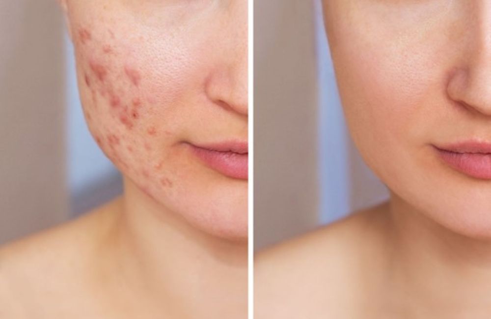 Acne Scarring Metropolis Dermatology Los Angeles